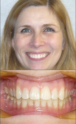 Rubber Bands Braces 101 - Orthodontics Limited