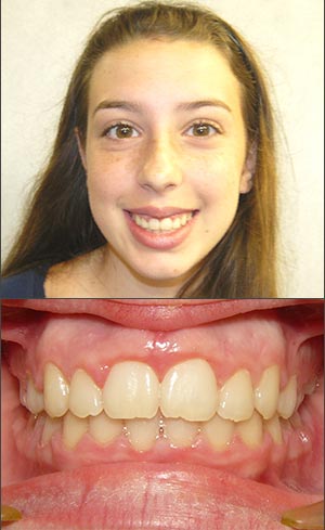 overbite before and after